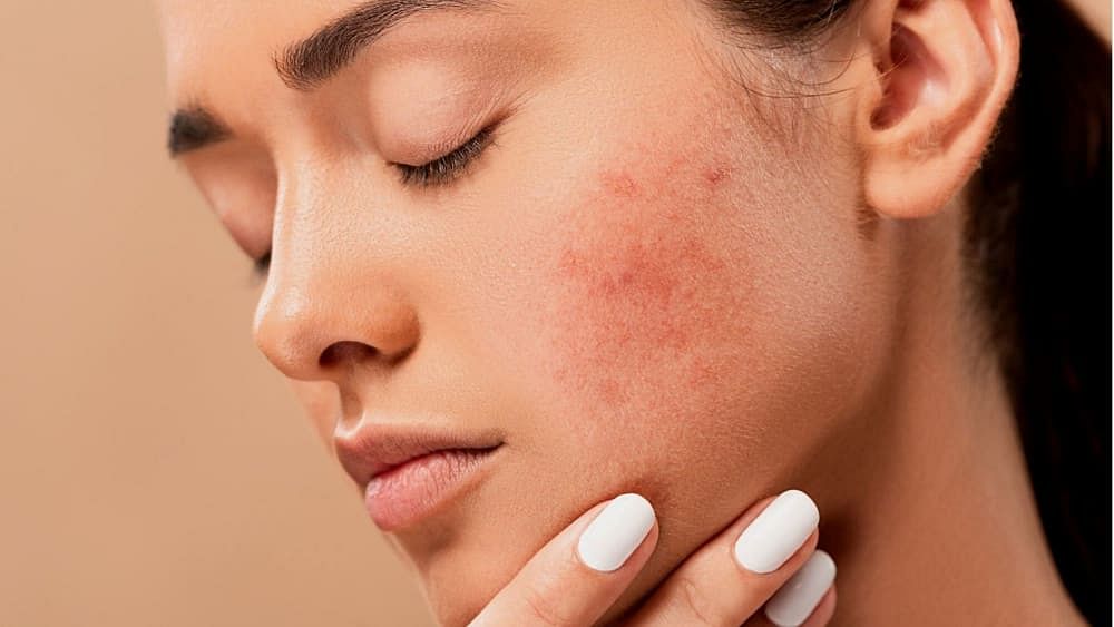 Period Acne: Signs, Causes & Best Remedies