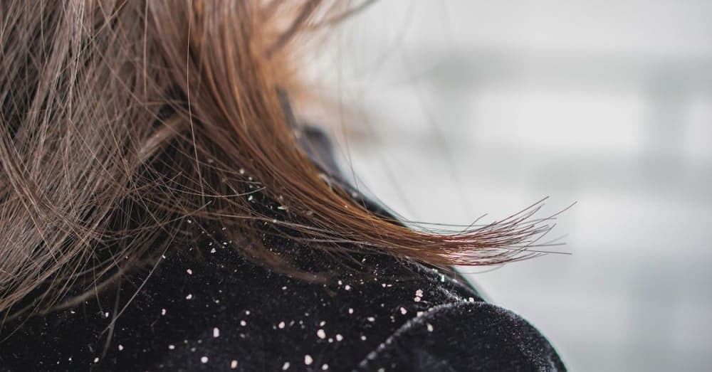 4 Types of Dandruff Causes, Preventions & Best Treatments