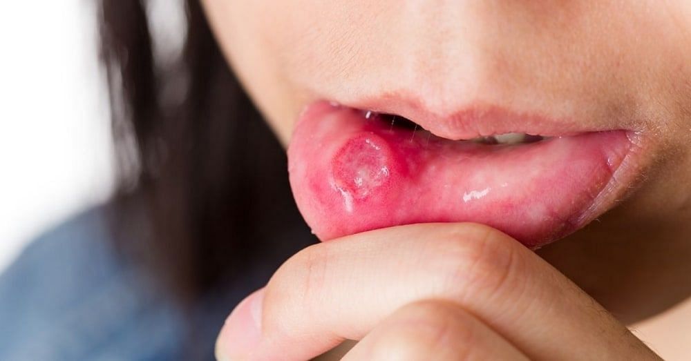 मुंह में छाले के उपाय | Home Remedies for Mouth Ulcers in Hindi