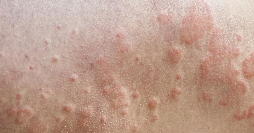 त्वचा पर लाल धब्बे के कारण | Reasons for Red Spots on the Skin in Hindi