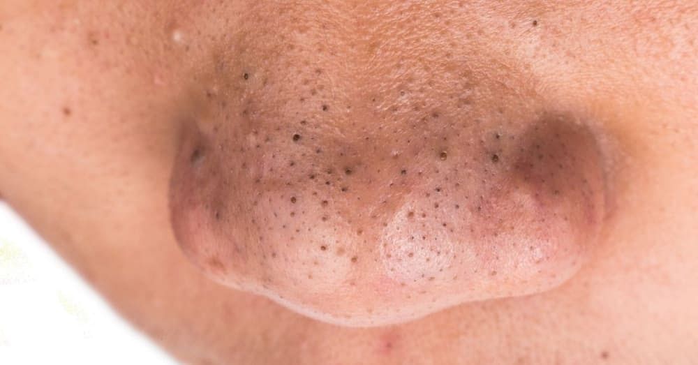 How to Get Rid of Blackheads on Nose - According to a Dermatologist