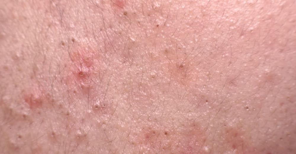 Nodular Acne: Causes, Treatment, Home Remedies & More