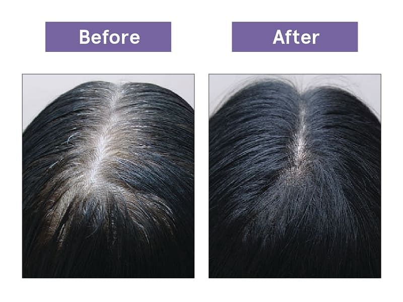https://ik.bebodywise.com/mosaic-wellness/image/upload/f_auto,w_800,c_limit/v1623501228/staging/products/Hair%20Growth%20Concentrate/Carousel%20NEW/before_after.jpg